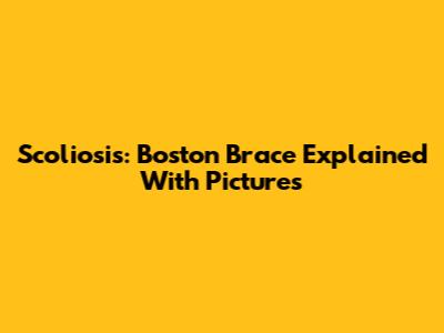 Scoliosis: Boston Brace Explained With Pictures